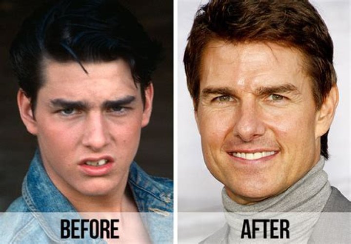 Tom Cruise Before And After Veneers