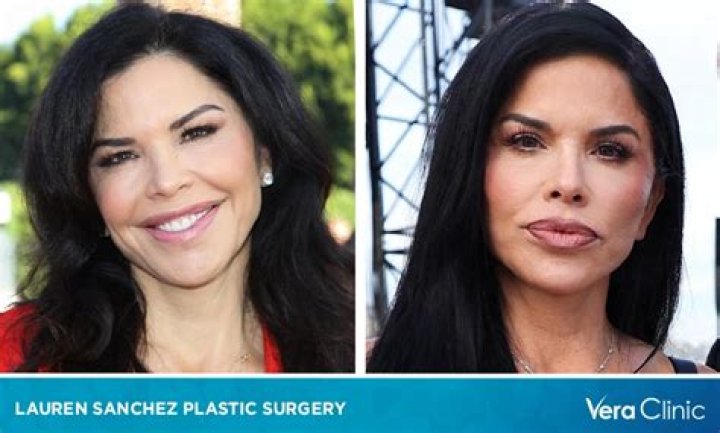 Unveiling The Truths Behind "Lauren Sanchez Plastic Surgery"